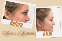 before and After Atrophic Acne Scars treatment in Islamabad