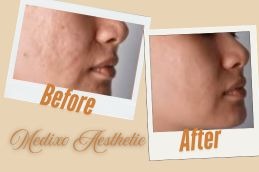 before and After Result Atrophic Acne Scars in Islamabad Pakistan