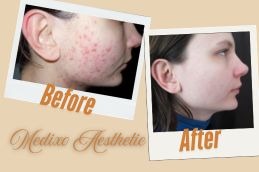 before and After Result Atrophic Acne in Islamabad Pakistan