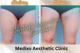 _before and After Thigh Liposuction in Islamabad & Pakistan