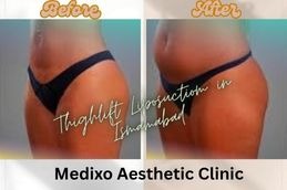 _before and After Thigh Liposuction in Islamabad Results