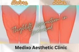 _before and After Thigh Liposuction in Islamabad