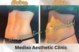 before and After results of 360 Liposuction Medixo