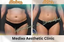 before and After results of 360 Liposuction in Islamabad , Pakistan