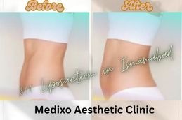 before and After results of 360 Liposuction in Islamabad ,Rawalpindi
