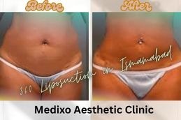 before and After results of 360 Liposuction in Islamabad ,Rawalpindi & Pakistan