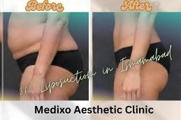 before and After results of 360 Liposuction in Islamabad ,Rawalpindi & Pakistan