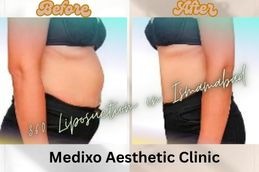 before and After results of 360 Liposuction in Islamabad
