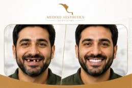 before and after dental implant Islamabad