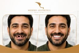 before and after dental implant Pakistan