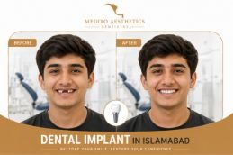 before and after dental implant Rawalpindi Pakistan