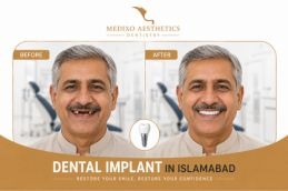 before and after dental implant Rawalpindi Pakistan