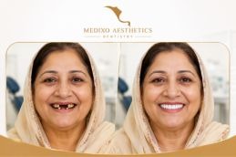 before and after dental implant in Islamabad Rawalpindi Pakistan
