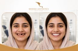 before and after dental implant