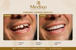 Before and After ceramic crown teeth in Islamabad