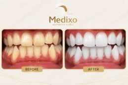 Before and After Teeth Whitening Strip in Islamabad
