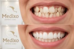 Before and after of Crooked teeth In Islamabad