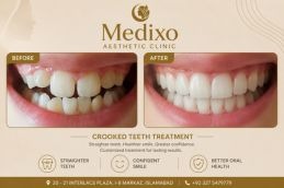 Before and after results of Crooked teeth In Islamabad Medixo
