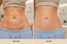 Before and after tummy tank medixo aesthetic islamabad