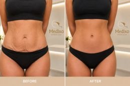 Before and after tummy tunk medixo