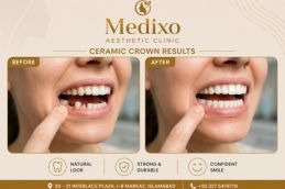 Ceramic Crown in Islamabad Results