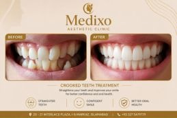 Crooked teeth in Islamabad before and after
