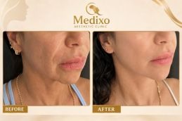 Dermal Fillers in Islamabad Before And After Results