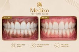 Gum Depigmentation in Islamabad before and after