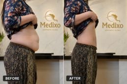 Liposuction before and after