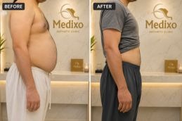 Liposuction in Islamabad before and after - Copy