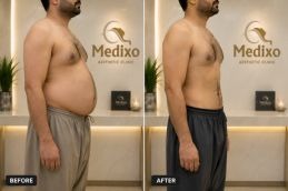 Liposuction in Islamabad brfore and after