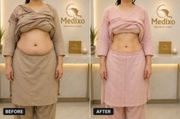 Liposuction in Islamabad results