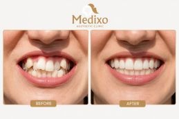 Overlapping Teeth Treatment Before and After