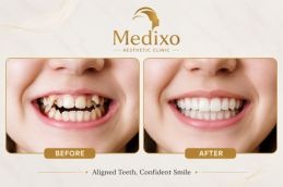 Overlapping Teeth Treatment IN Islamabad before and after