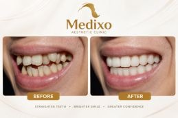Overlapping Teeth Treatment In islamabad Results