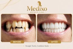 Overlapping Teeth Treatment Results