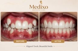 Overlapping Teeth Treatment Islambad