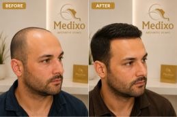 Result of hair transplant