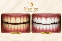 Results OF Teeth Whitening in Islamabad