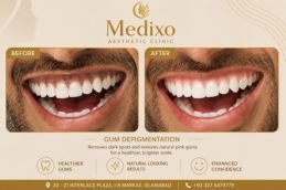Results of Gum Depigmentation in Islamabada