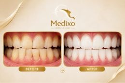 Results of Teeth Whitening Strip