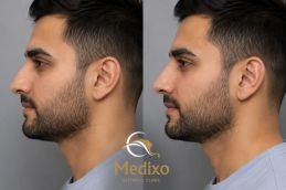 Rhinoplasty Nose Reshaping in islamabad and rawalpindi