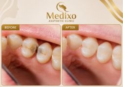 Root Canal Islamabad Medixo