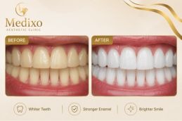 Before and after of Teeth Polishing and Scaling In Islamabad