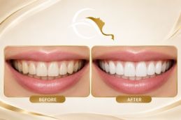 Teeth Whitening Strip before and after