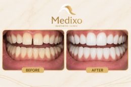 Teeth Whitening in Islamabad Results before and after