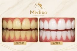 Teeth Whitening in Islamabad treatment results