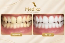Teeth Whitening in Islamabad Before and After