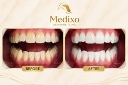 Teeth Whitening in Islamabad Results