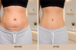 Tummy tunk islamabad medixo asethetic